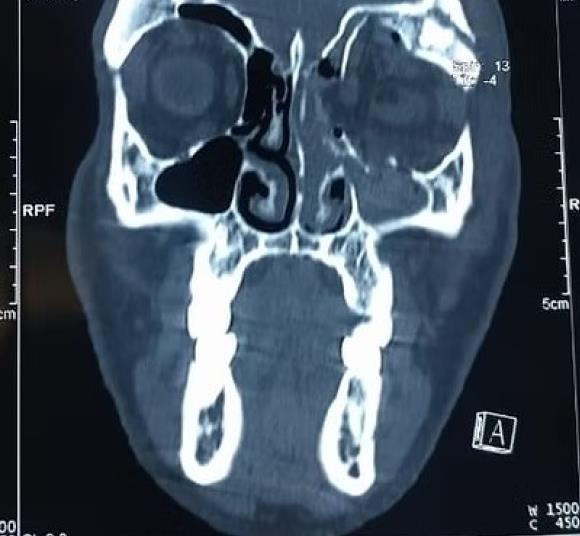 CT scan of orbital fracture