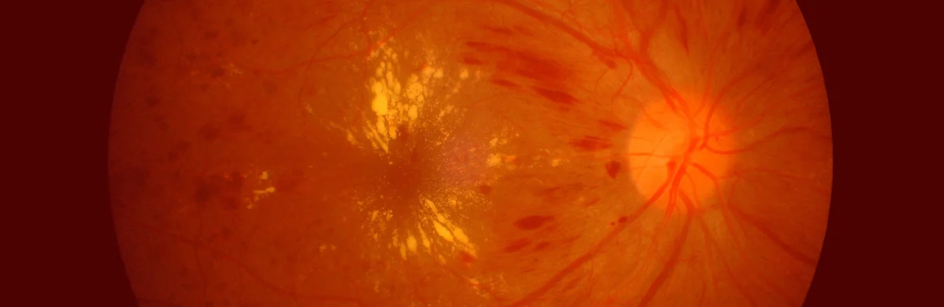 Diabetic Retinopathy fundus image