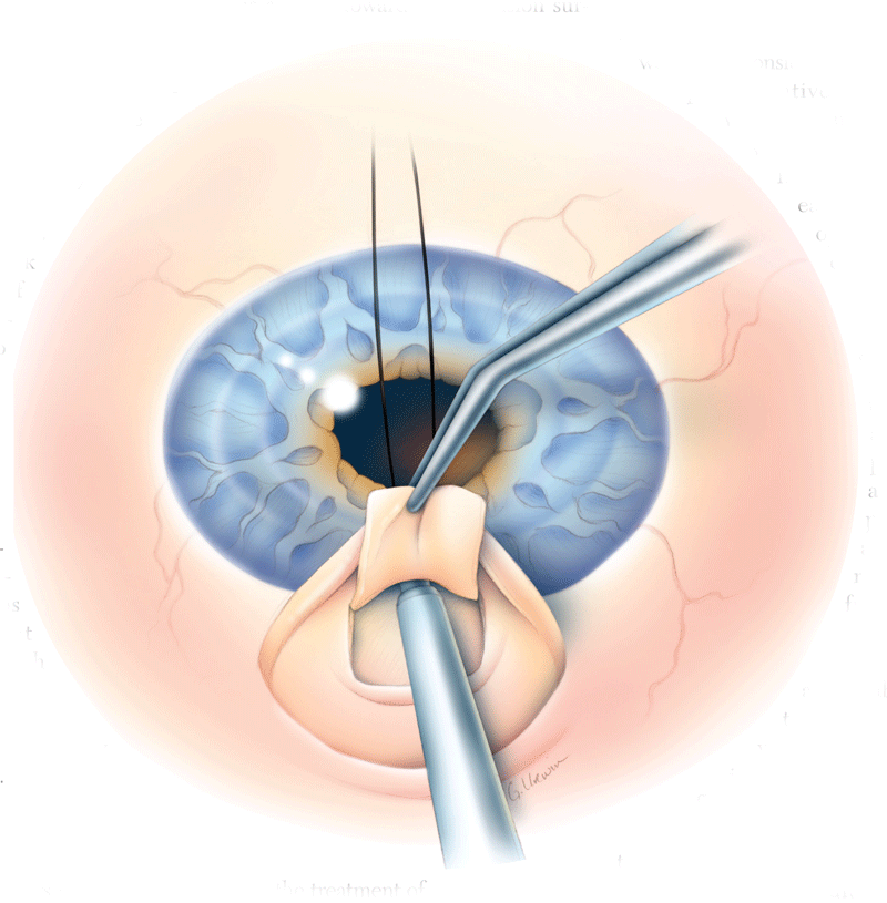 Trabeculectomy surgical procedure