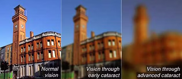 Progressive vision loss from cataract