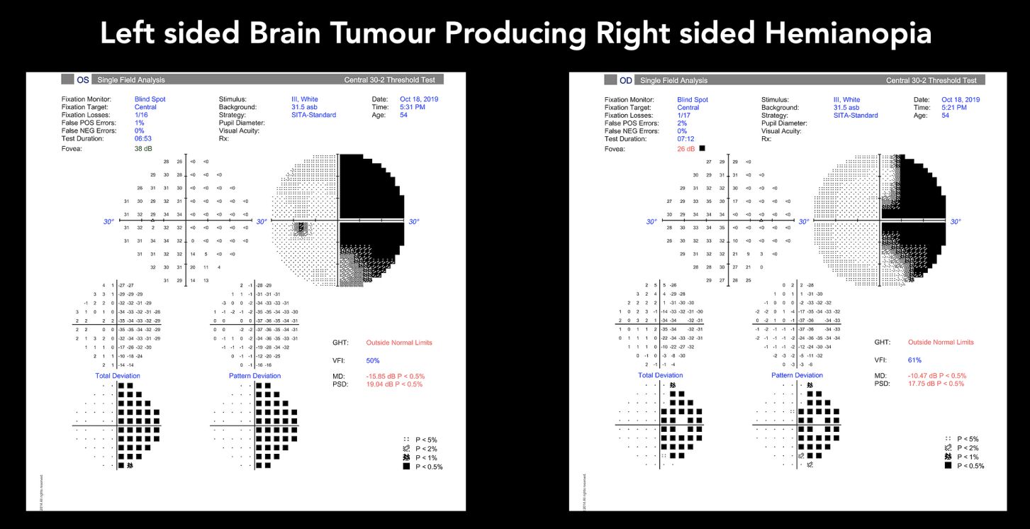 Visual field test showing hemianopia