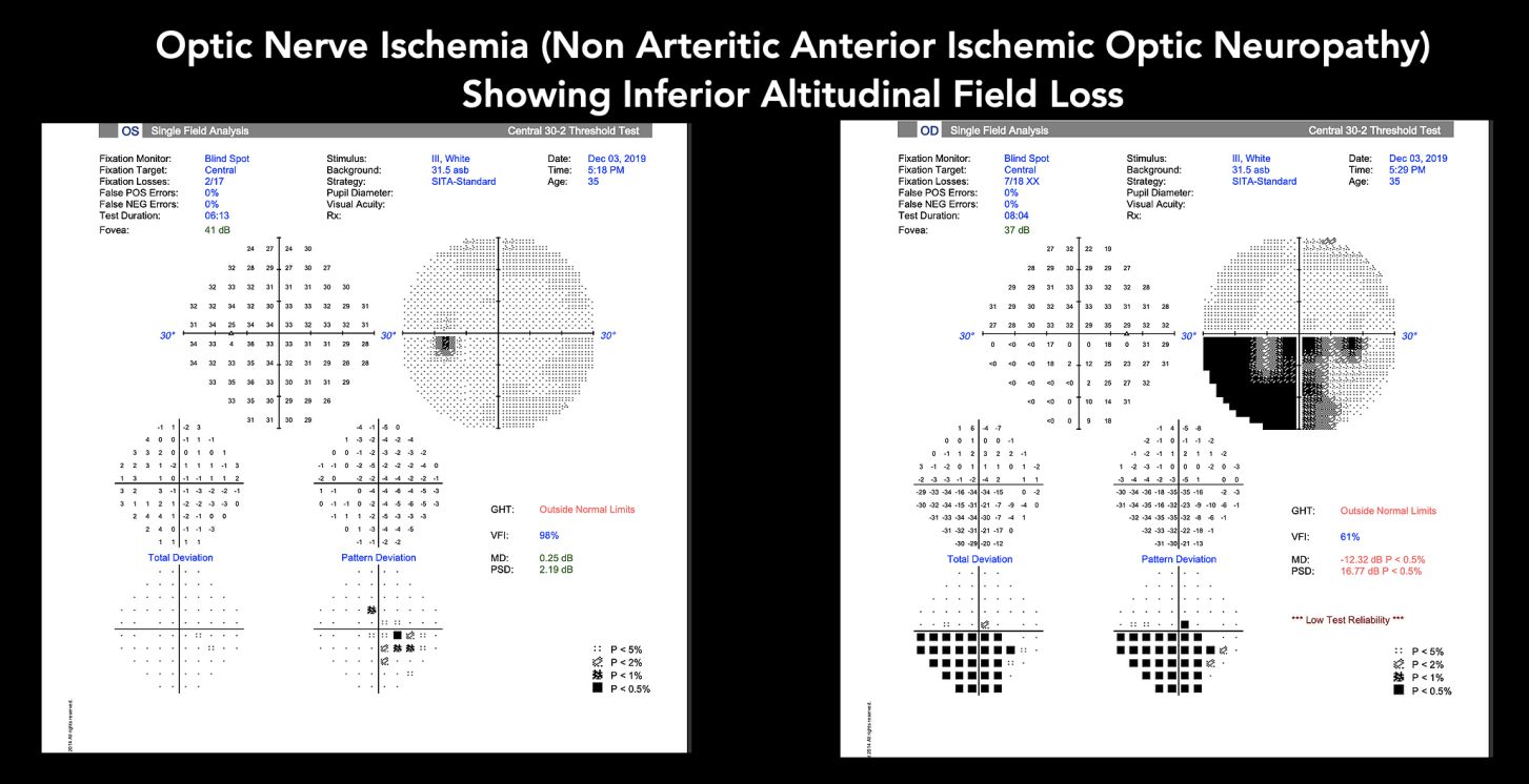 Visual field test showing bi temporal hemianopia