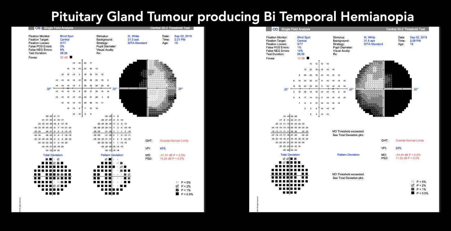 Visual field test showing inferior altitudinal field loss