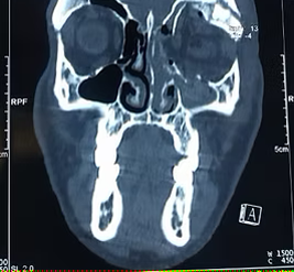 CT scan of orbital fracture