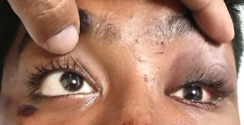 Orbital fracture patient