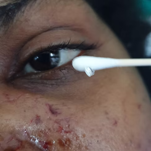 Removal of glass foreign body