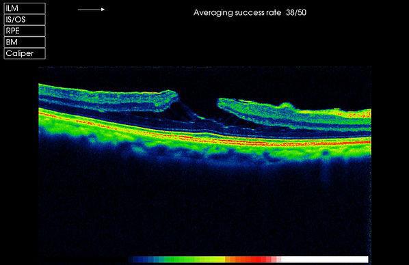 Normal vs Glaucoma nerve fiber analysis