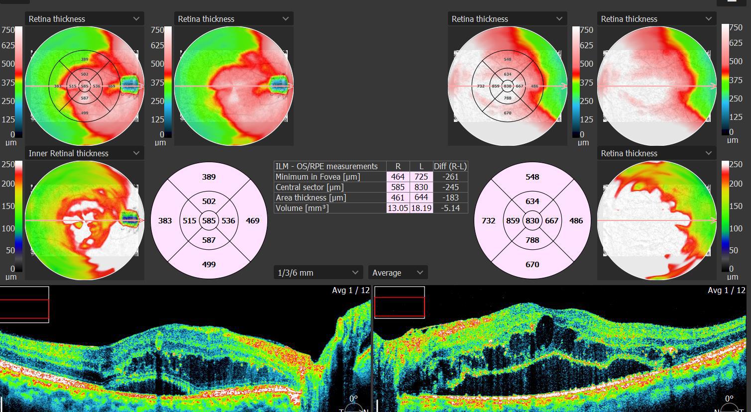 Normal vs Glaucoma nerve fiber analysis