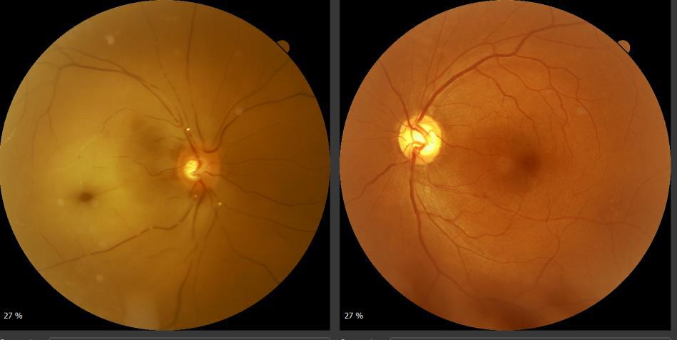 Normal vs Glaucoma nerve fiber analysis