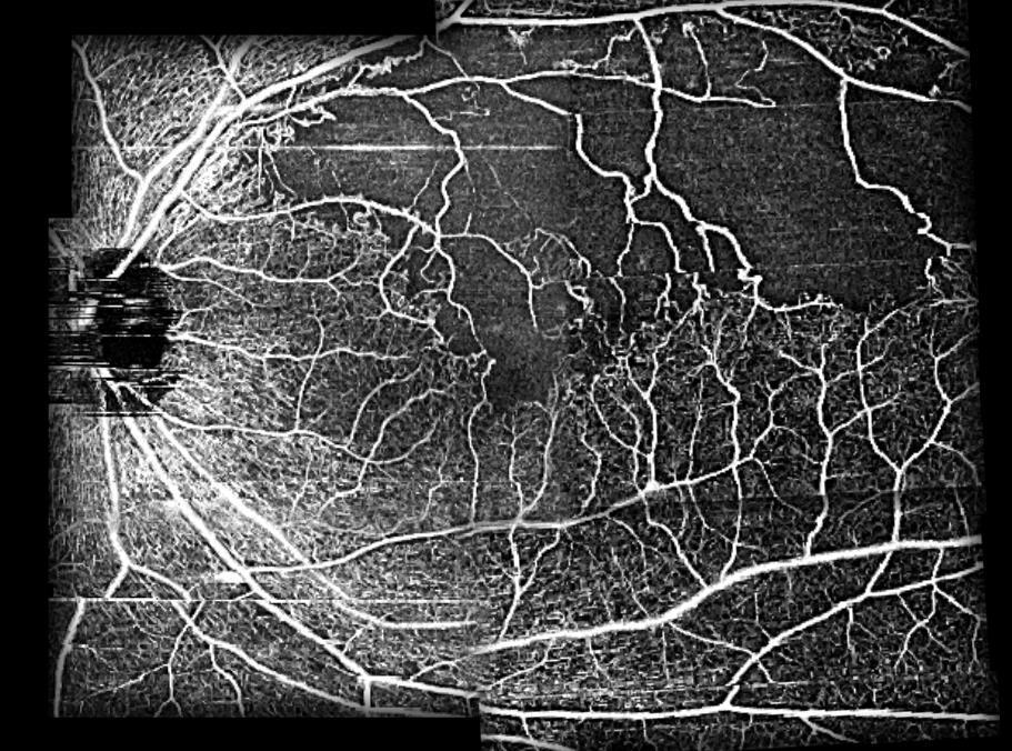 Visual Field Test Results