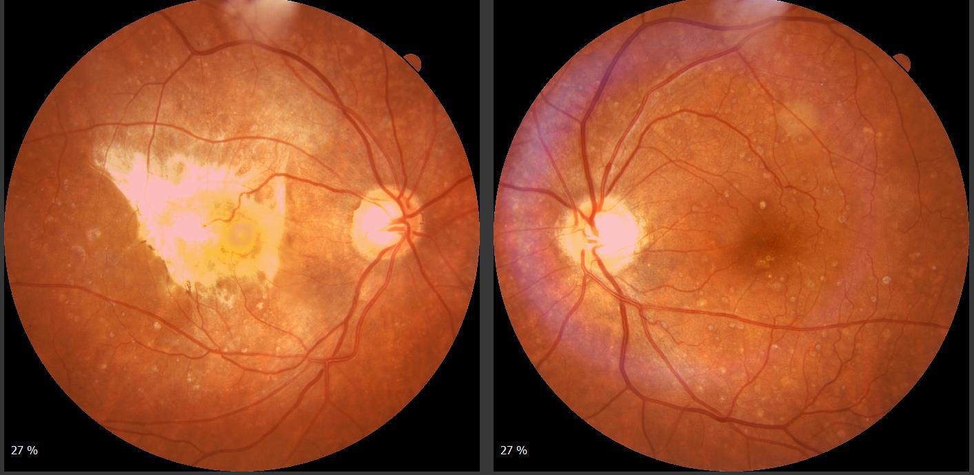 Normal vs Glaucoma nerve fiber analysis